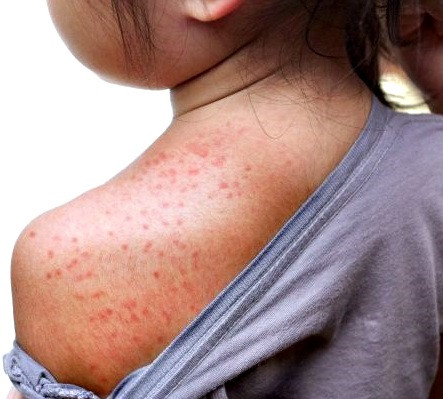 2ª etapa da imunização contra o Sarampo será em agosto